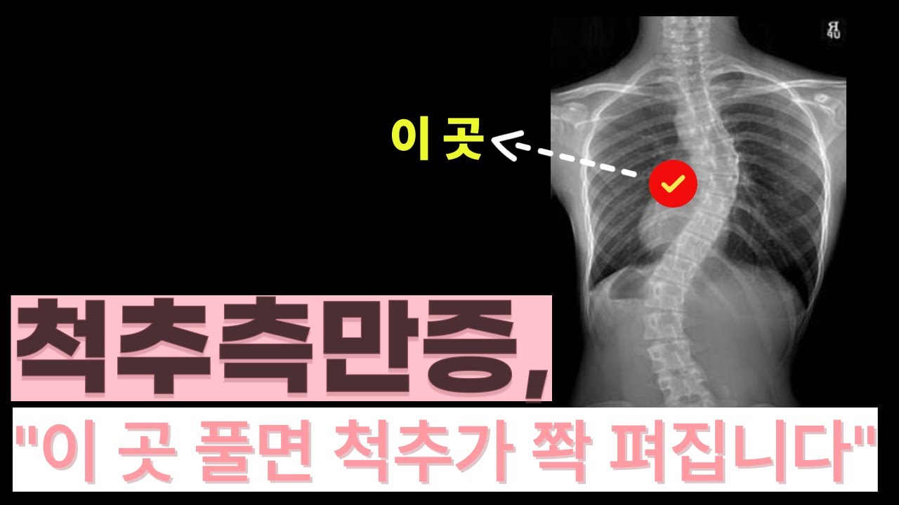 99%가 모르는 척추측만증 교정법, 이걸 몰라서 척추가 그대로입니다.