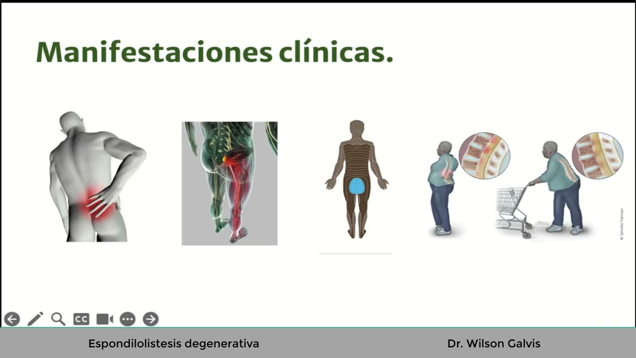 Espondilolistesis degenerativa