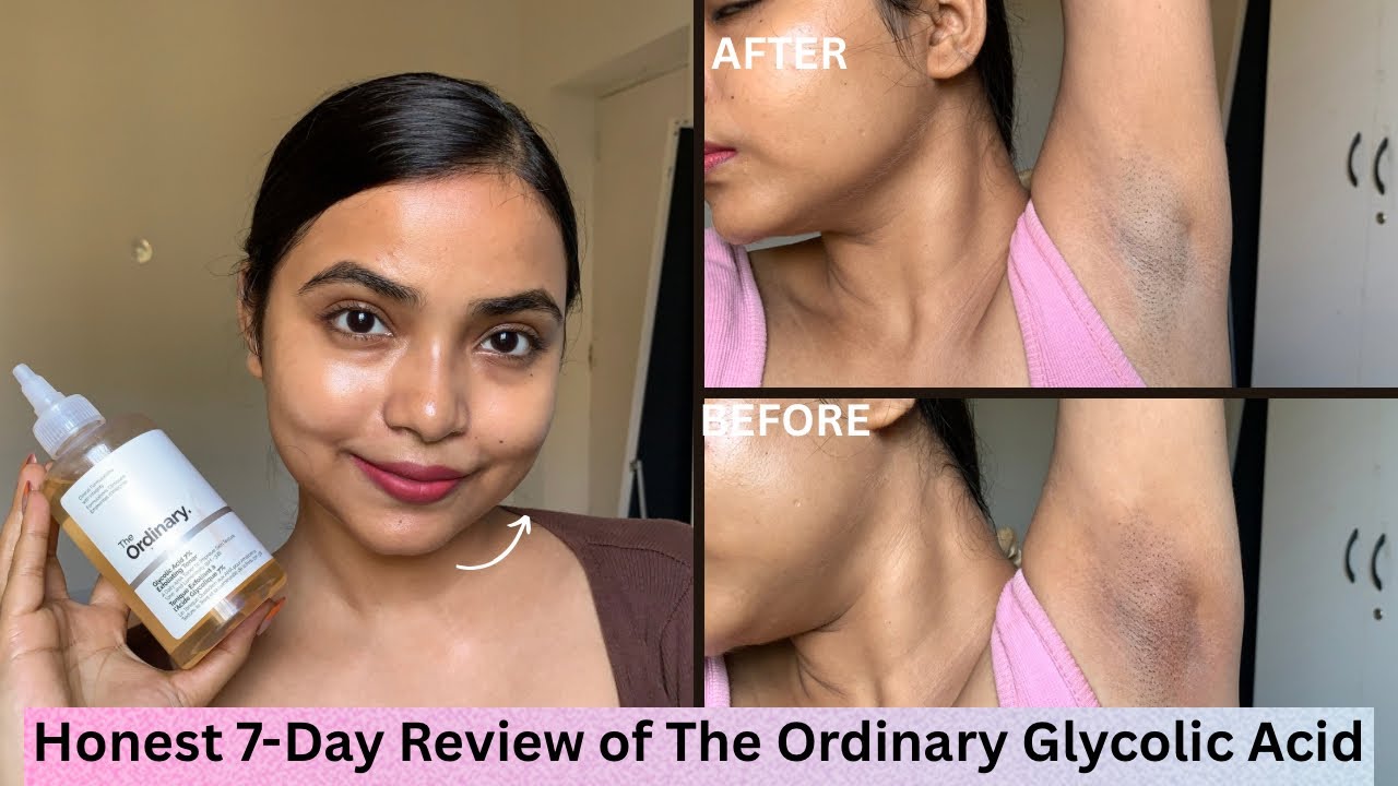7 Days of The Ordinary Glycolic Acid&ndash; Underarm Test!&bull;Underarm pigmentation &bull;Dark underarms treatment