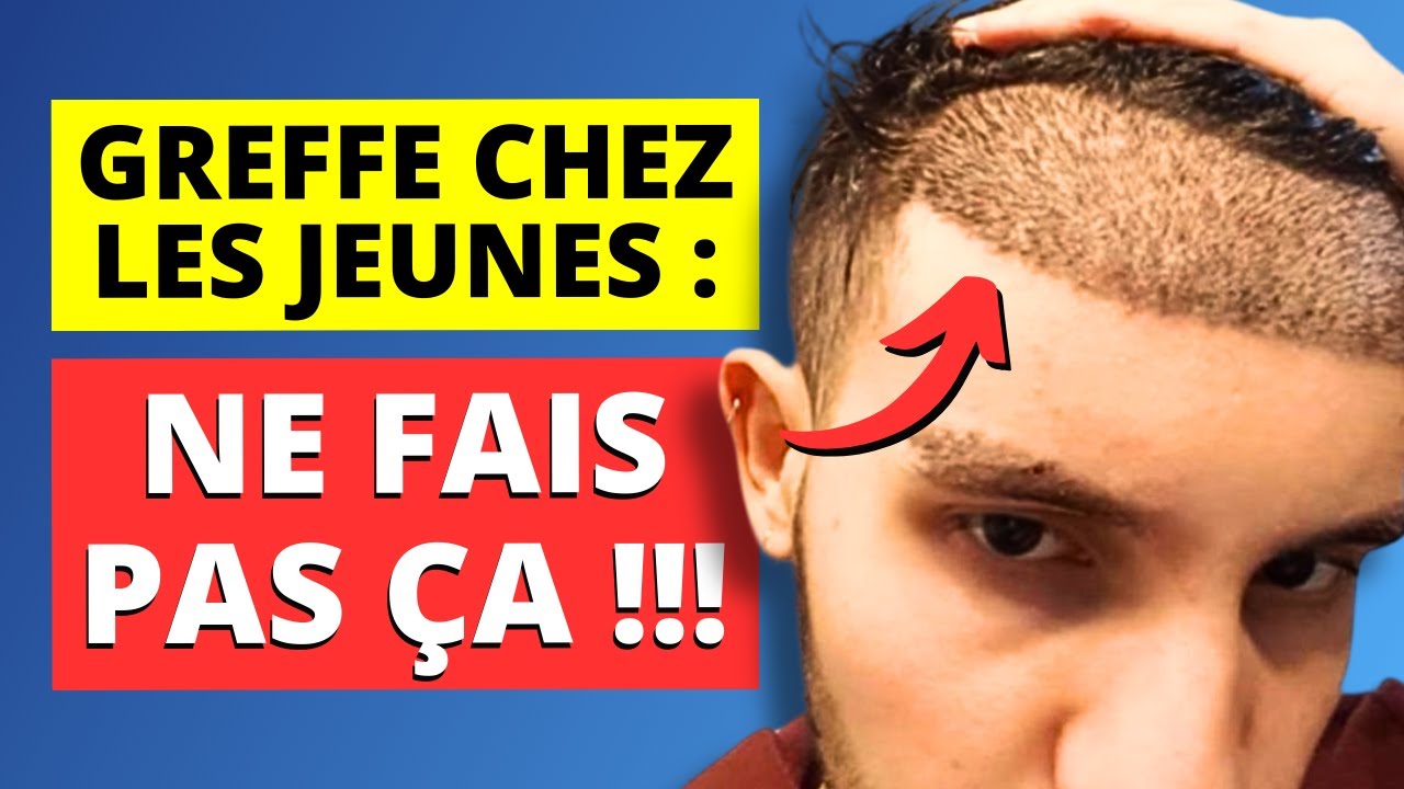 Greffe de cheveux : 4 Erreurs 