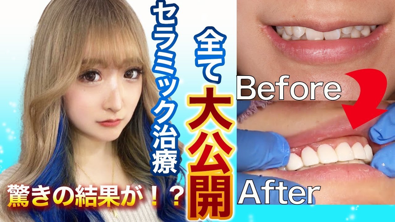 【セラミック治療】るんちゃん×前田先生