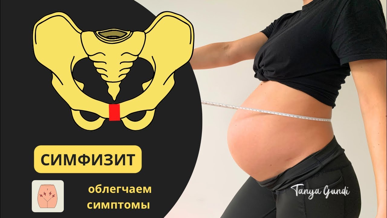 КАК ОБЛЕГЧИТЬ СИМФИЗИТ 🤰БОЛЬ В ПАХУ ⚡️ И ВО ВРЕМЯ БЕРЕМЕННОСТИ