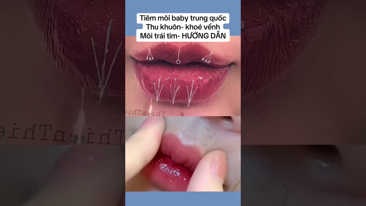 Hướng dẫn kỹ thuật tiêm môi baby Trung Quốc 