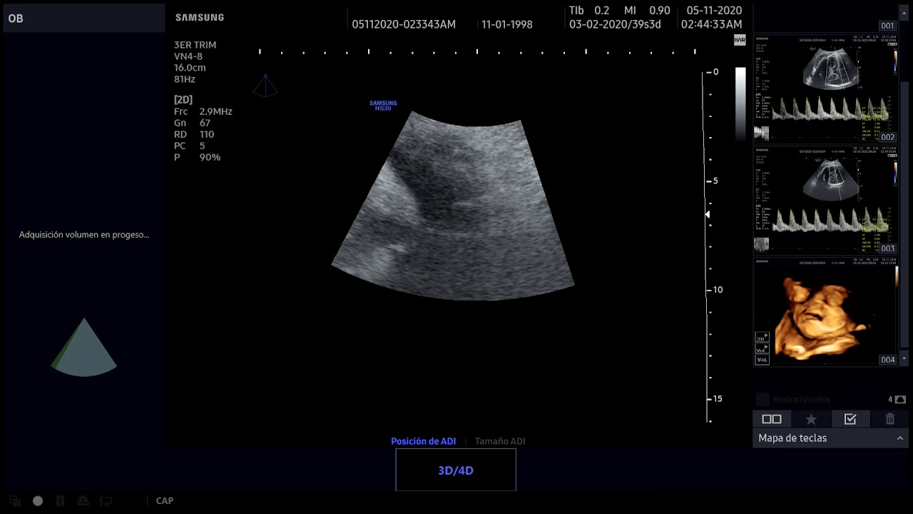 Ecografía Obstétrica con el HS30 v1.01 de Samsung