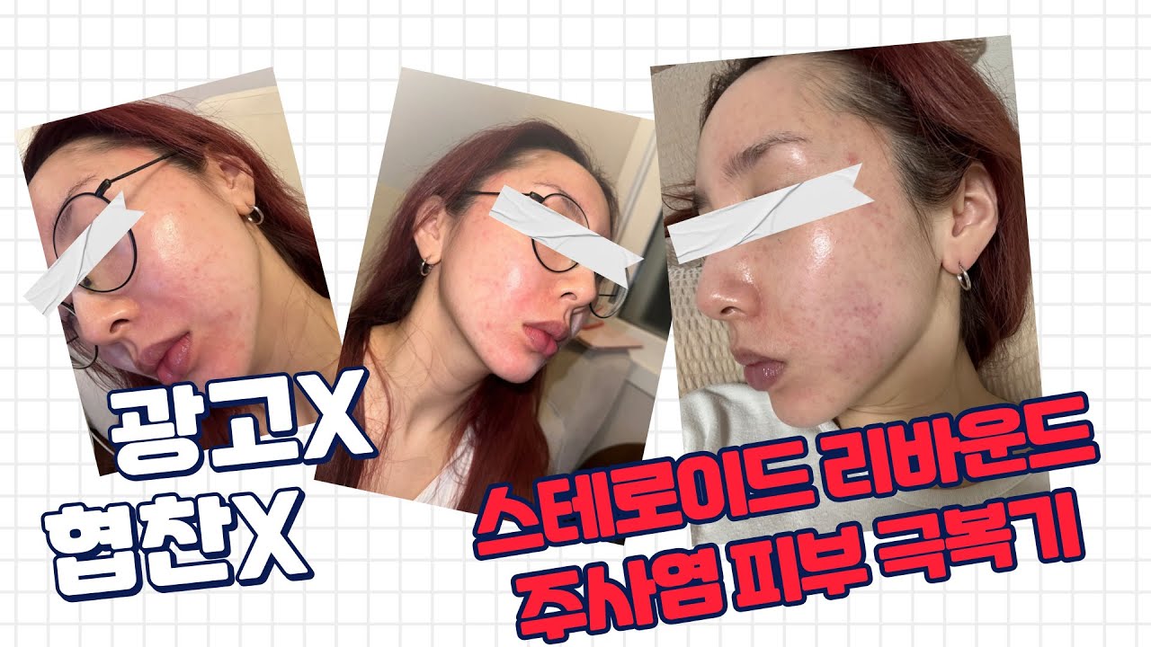 스테로이드 연고 리바운드 부작용 극복기/ 주사피부염/ 피부장벽/ 제품추천