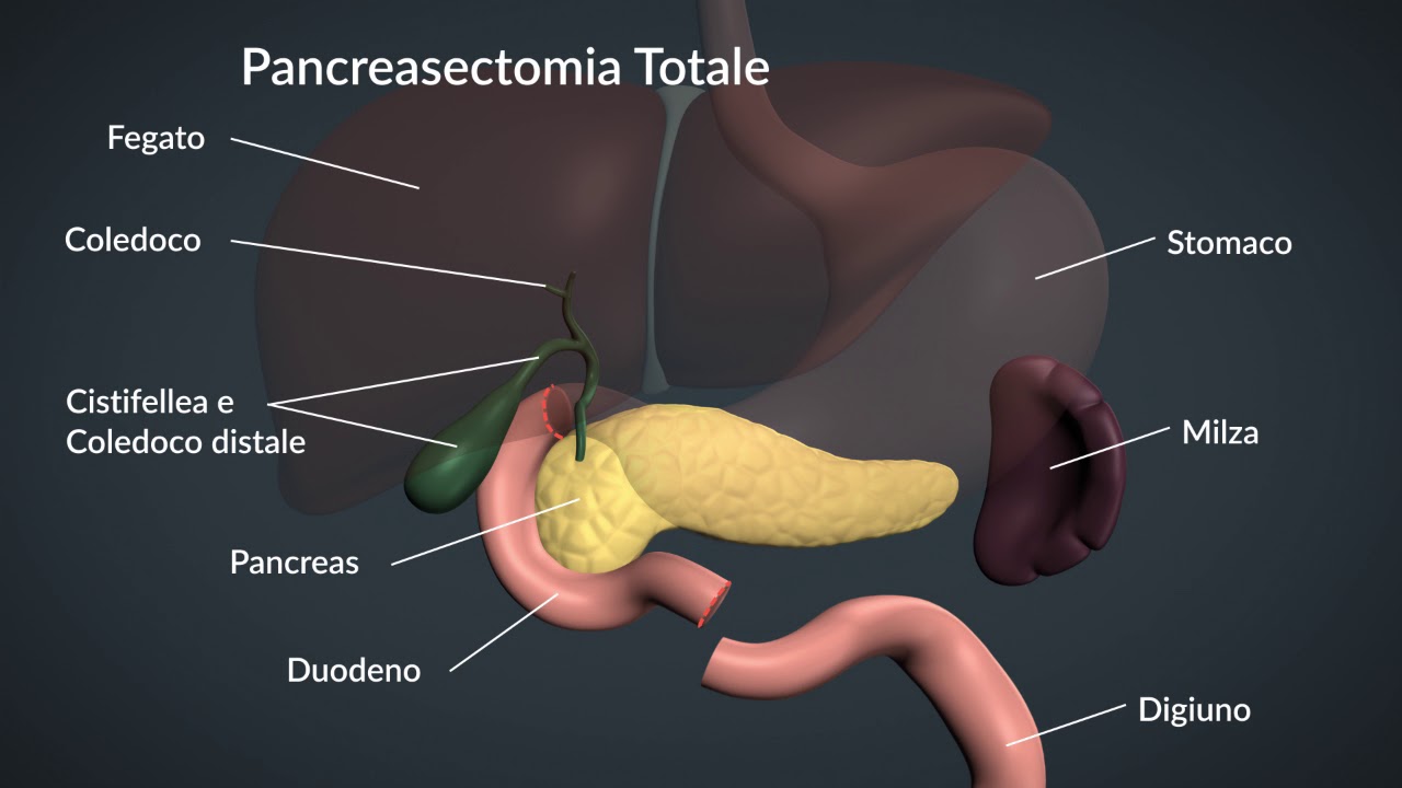 09 pancreasectomia totale