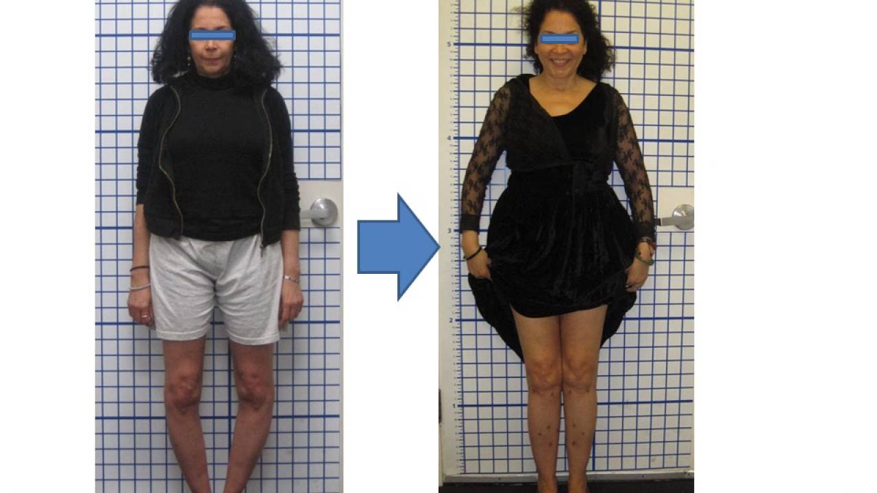 Dr. Robert Rozbruch - Bowleg Correction