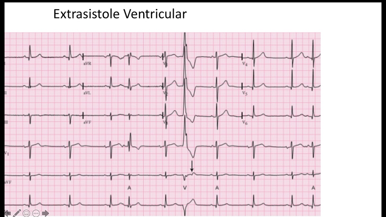 Extrasistole Ventricular  EKG