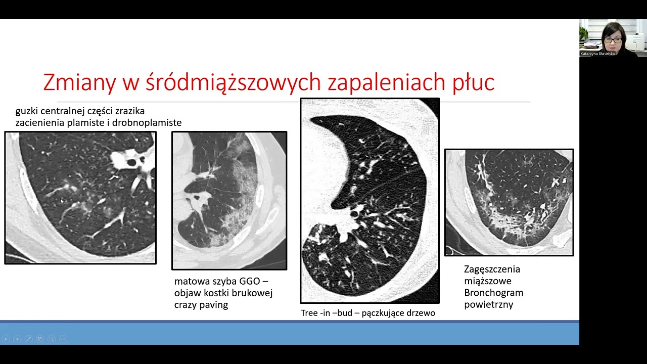 K. Błasińska - Zapalenie płuc na ostrym dyżurze.