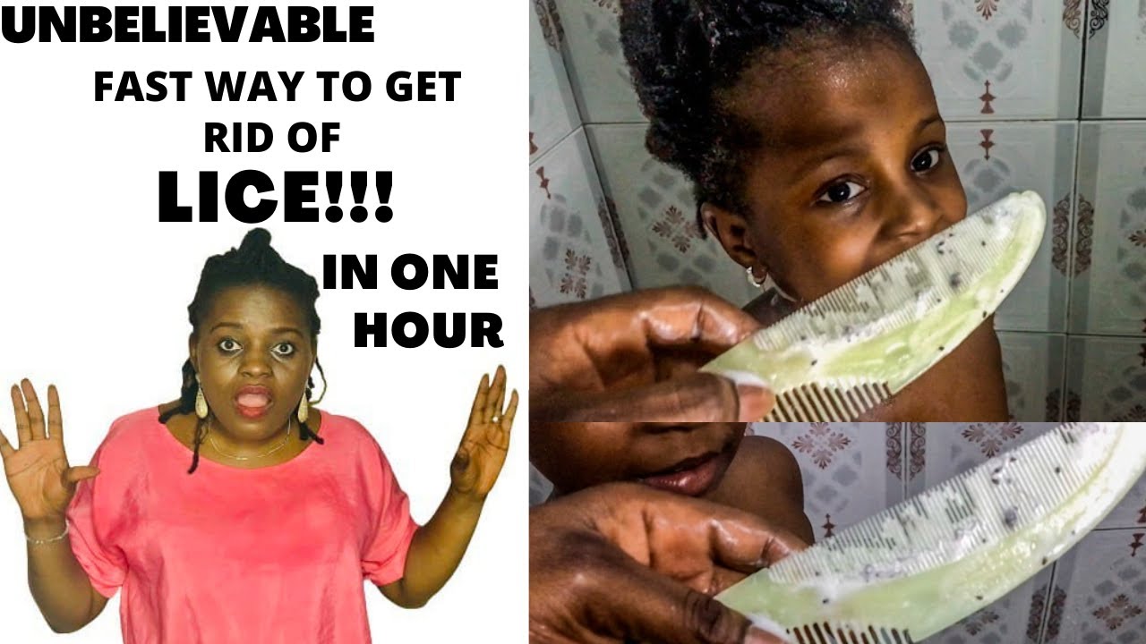 How to Get Rid of Head Lice in 1 Hour !!! (Very Simple Technique) #nigerianyoutuber #portharcourt