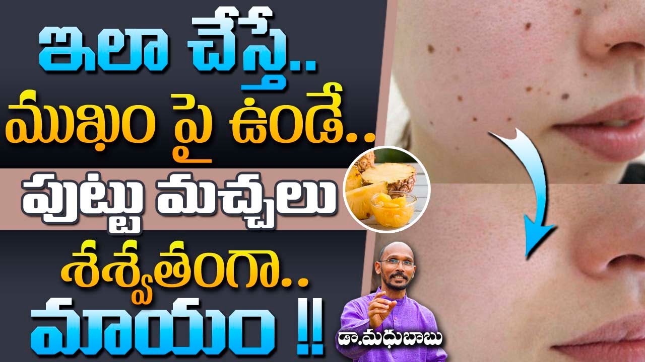 ఇలా చేస్తే ముఖం పై ఉండేపుట్టు మచ్చలు శాశ్వతంగా మాయం | Dr. Madhu Babu | Health Trends |