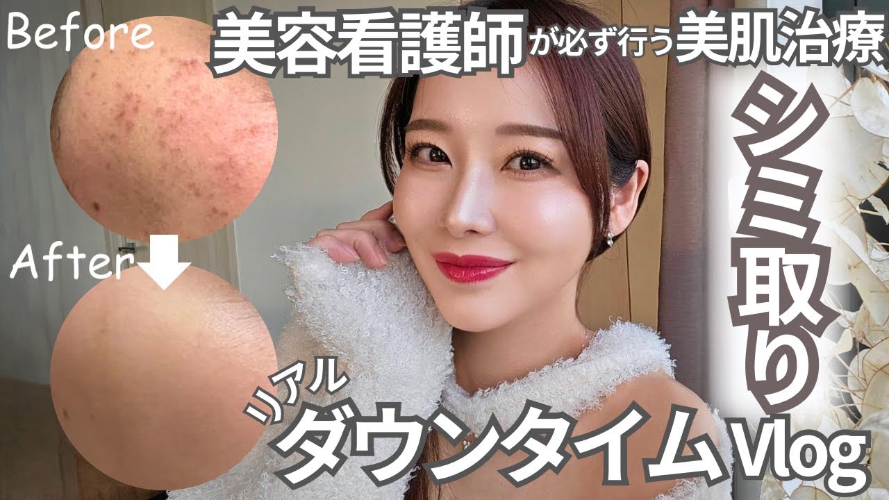 【ダウンタイム美容vlog】美容看護師のリアルケア。愛用品、ダウンタイム隠しコスメ、スキンケア、美容ルーティン、シミ取り経過レポ。