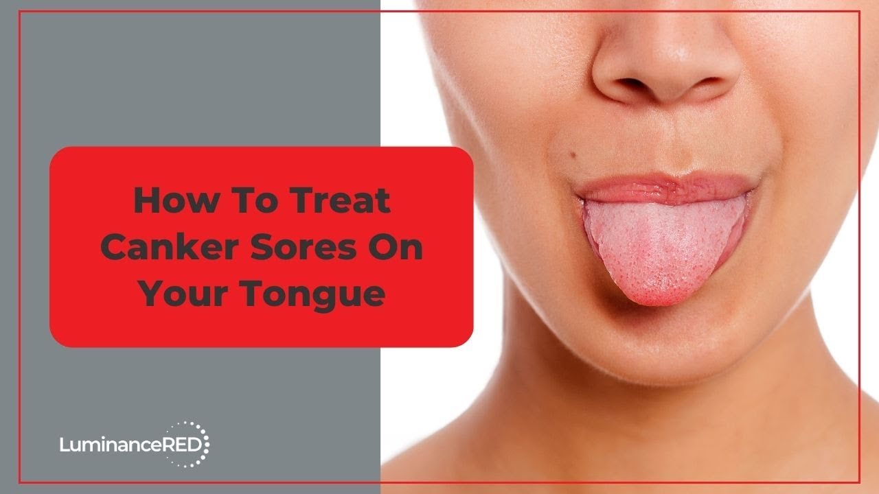 How to Treat Canker Sores on Your Tongue