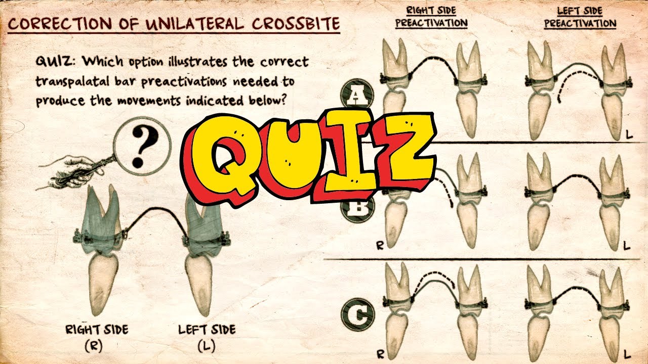 Unilateral Crossbite Correction | Essential Biomechanics