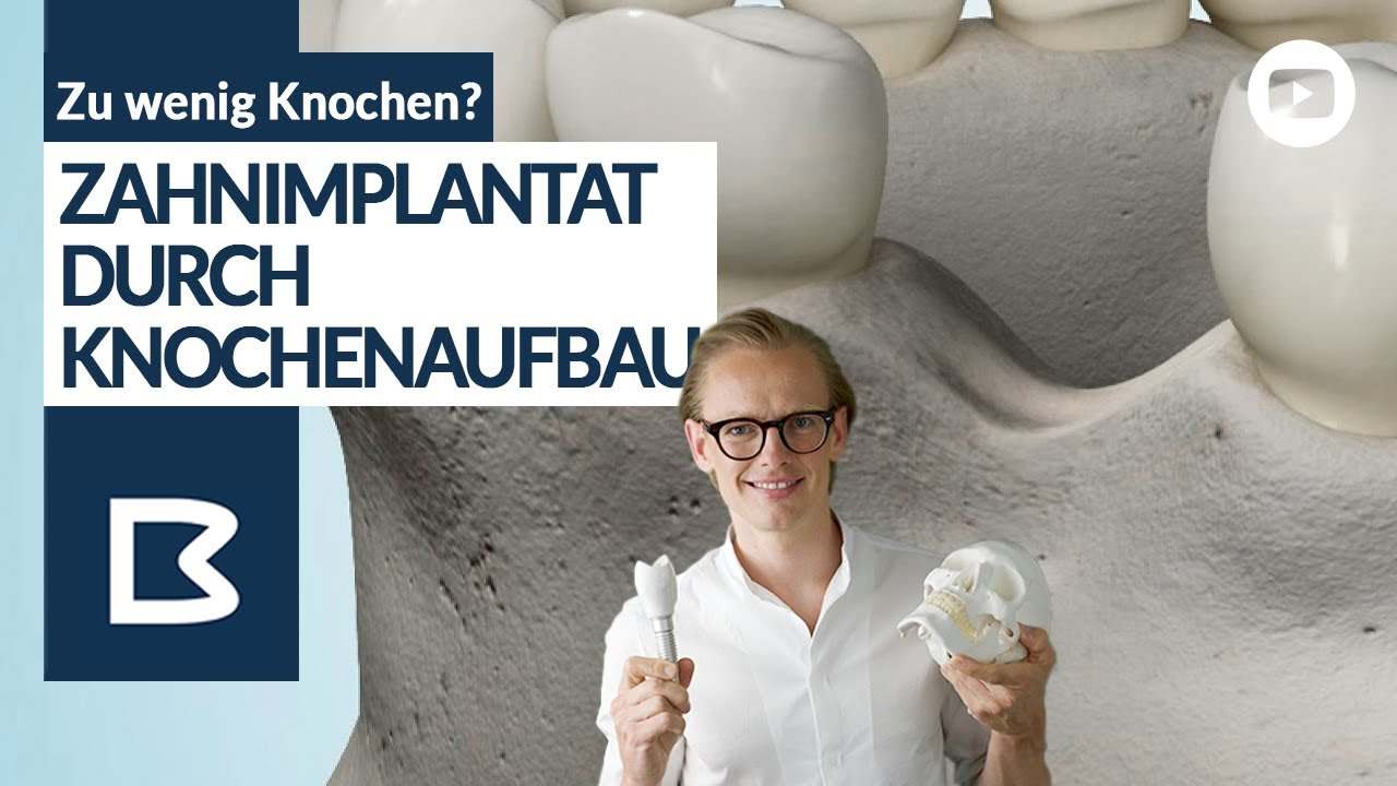 Knochenaufbau f&uuml;r Zahnimplantate - Alle M&ouml;glichkeiten genau erkl&auml;rt!