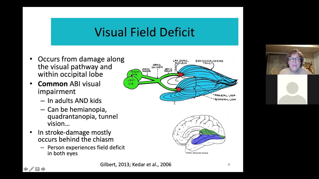 Hemianopia the Hidden Impairment following PCA Stroke (Nov. 2, 2021)