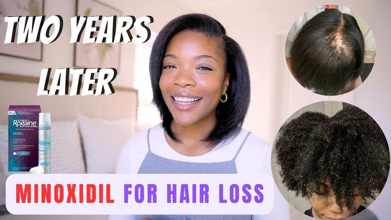 Minoxidil Two Year Hair Regrowth Update #minoxidil #hairgrowth