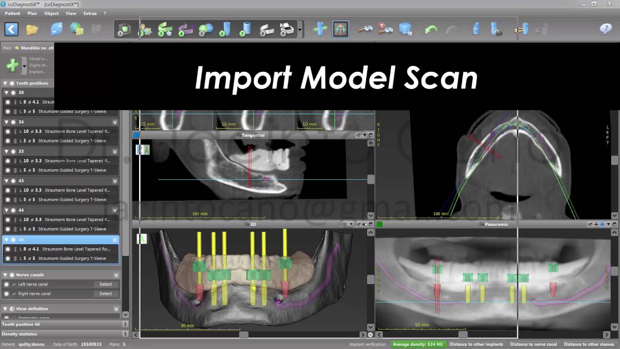 coDIagnostiX for Edentulous Patients: Single CBCT and Retention Pins