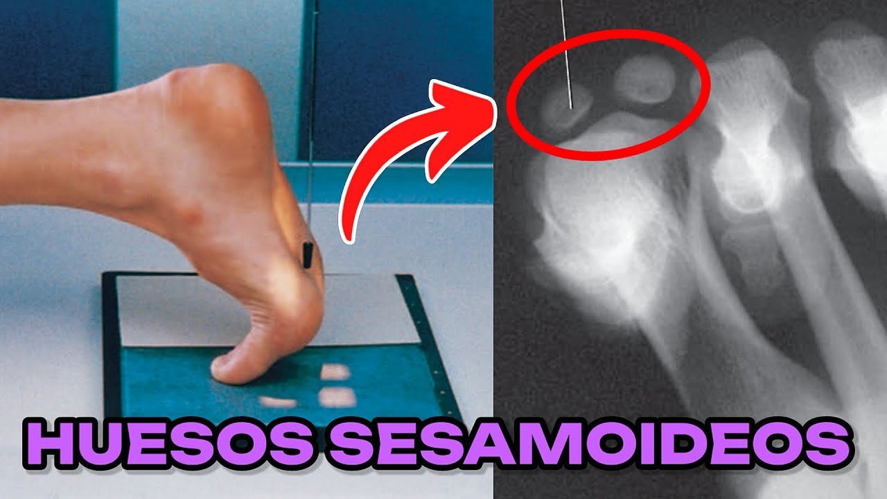 RADIOGRAFÍA TANGENCIAL DE DEDOS DEL PIE: SESAMOIDEOS (MANUAL DE BOLSILLO) #37