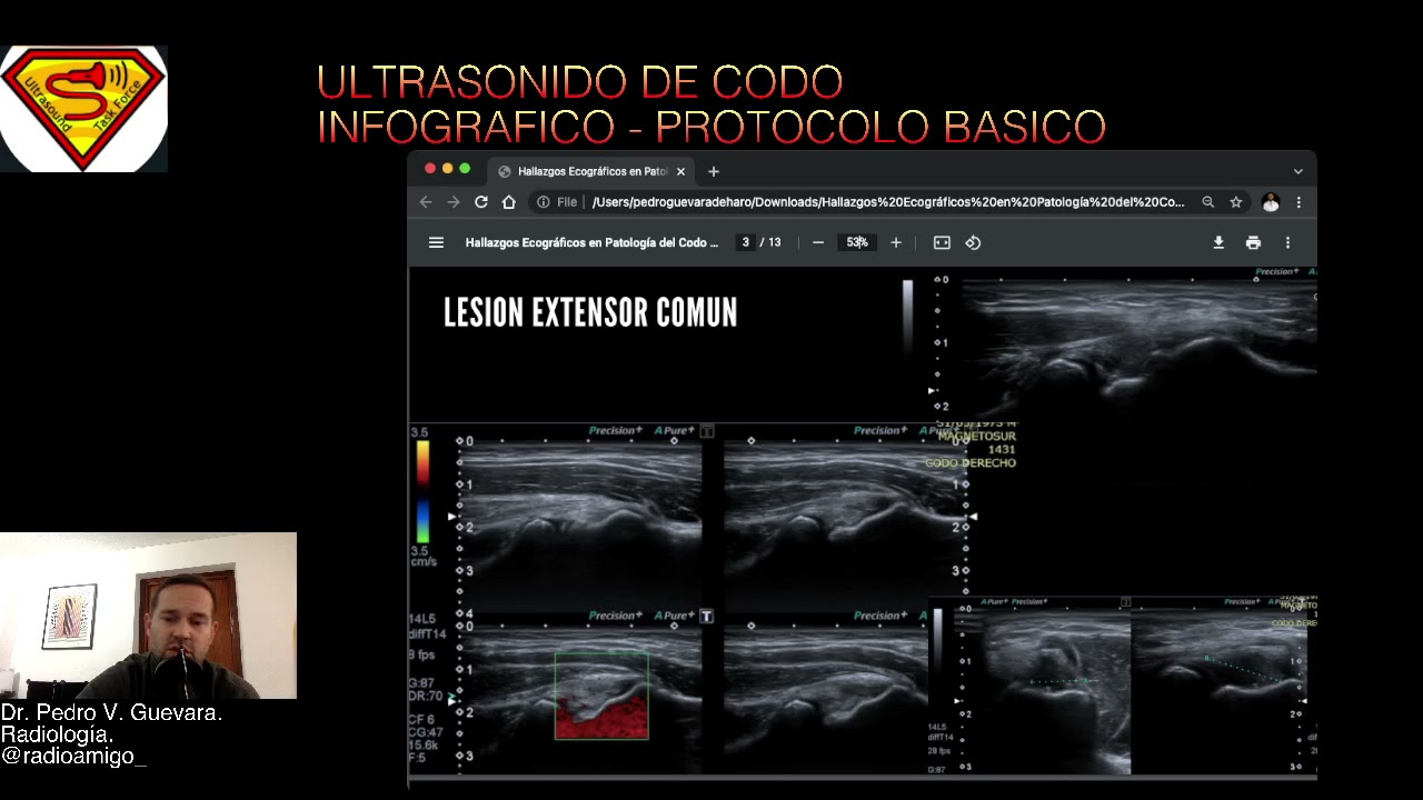 Hallazgos Ecograficos en patologia del codo 1 : 2