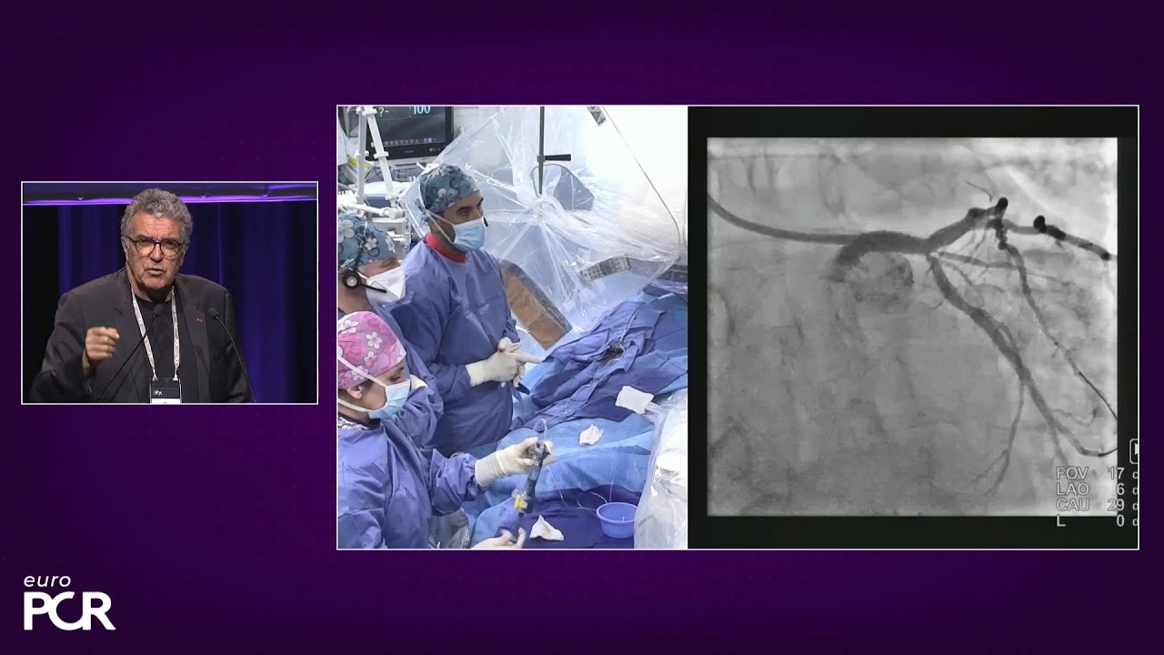Transradial approach, from complex PCI to peripheral intervention