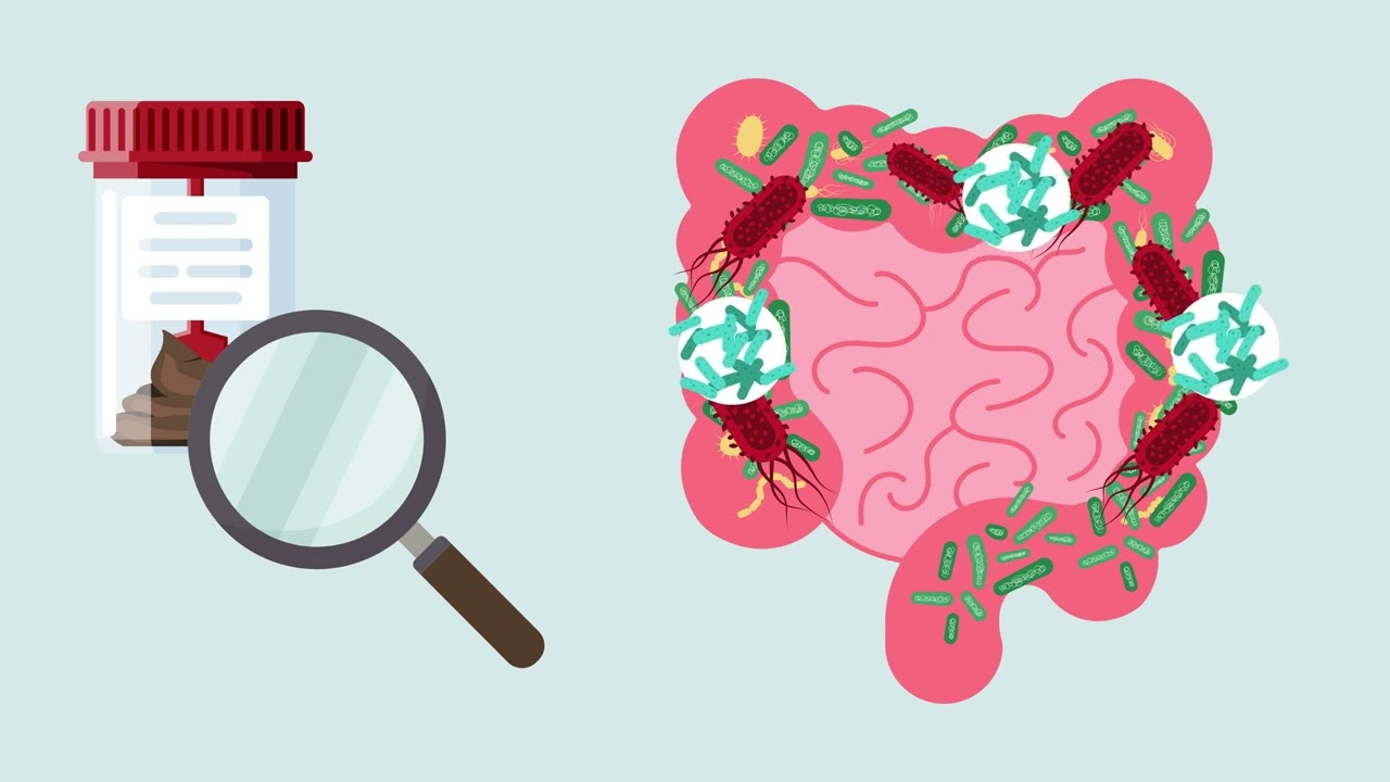 Трансплантация кала при рецидивирующей инфекции Clostridioides difficile (C. diff.)