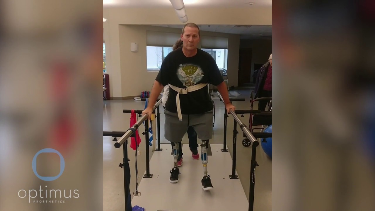 Motivated Bilateral Amputee Learns to Walk on His New Permanent Prostheses