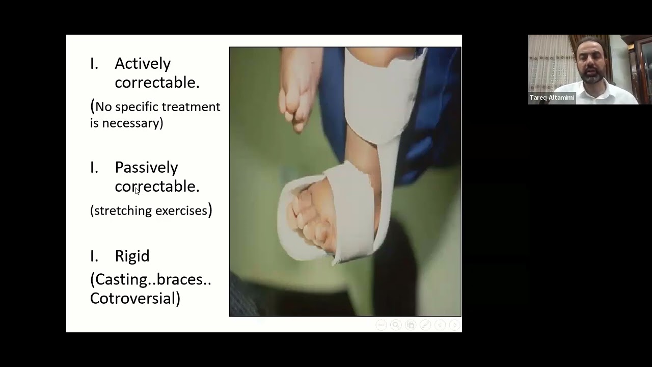 Metatarsus Adductus Correction