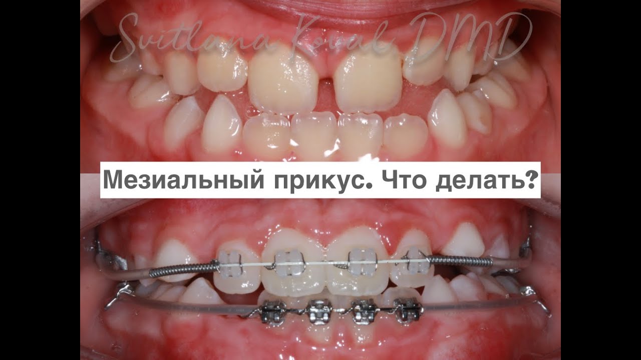 Мезиальный прикус, сужение верхней челюсти  Планирование ортодонтического лечения