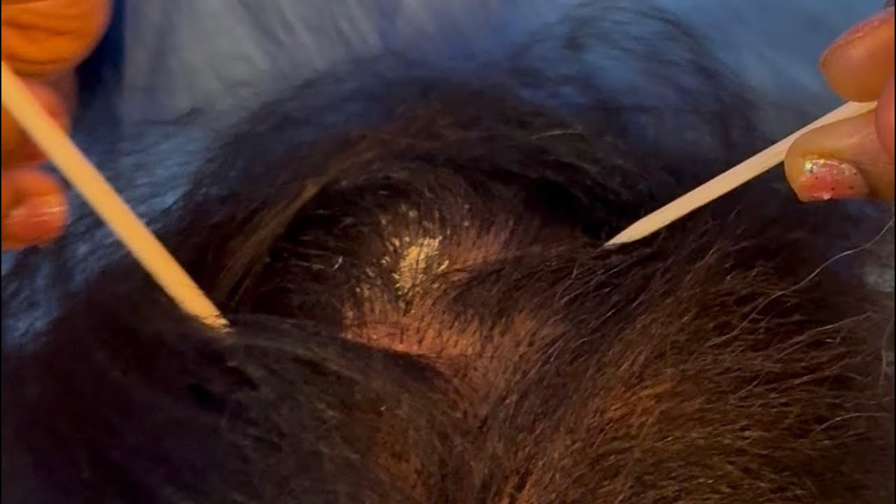 Layered dandruff removal. 