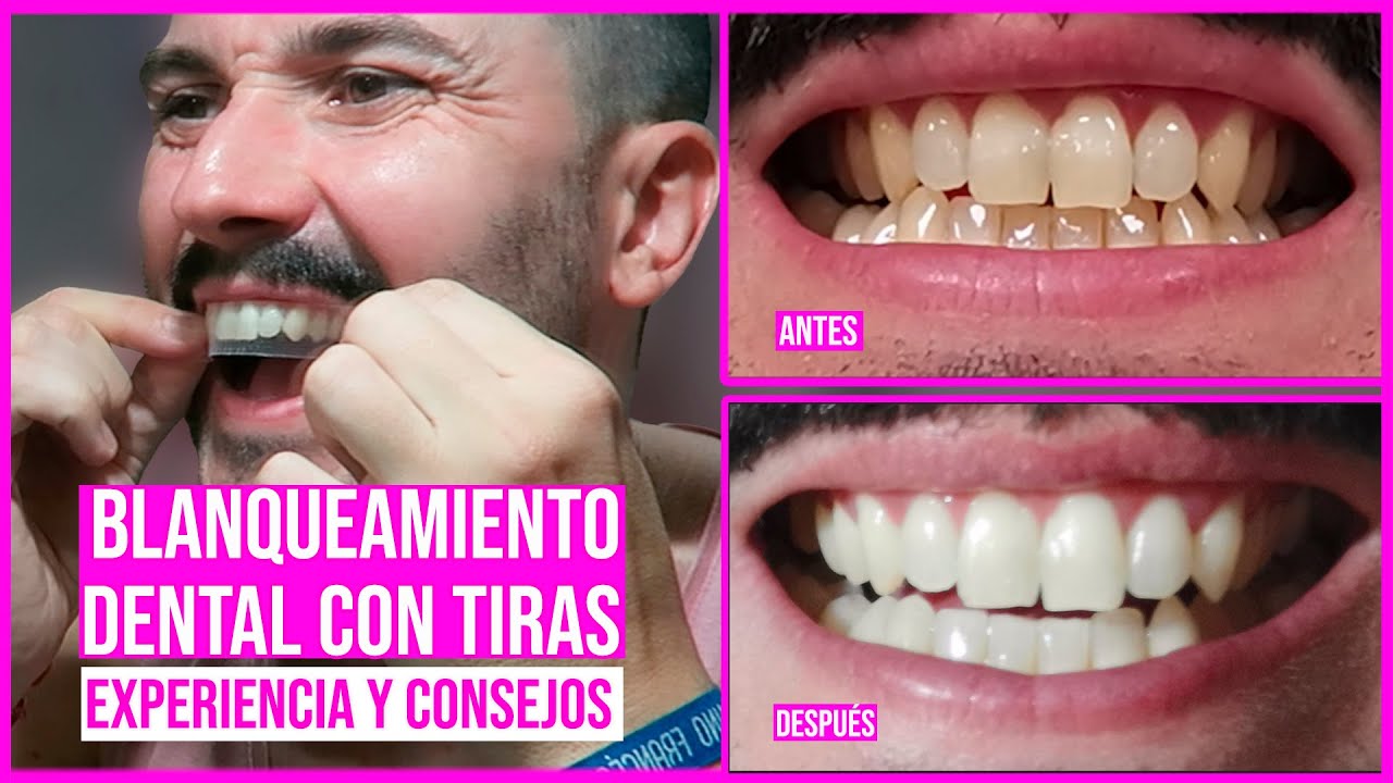 DIENTES más BLANCOS en 30 minutos con TIRAS BLANQUEADORAS - EXPERIENCIA y CONSEJOS