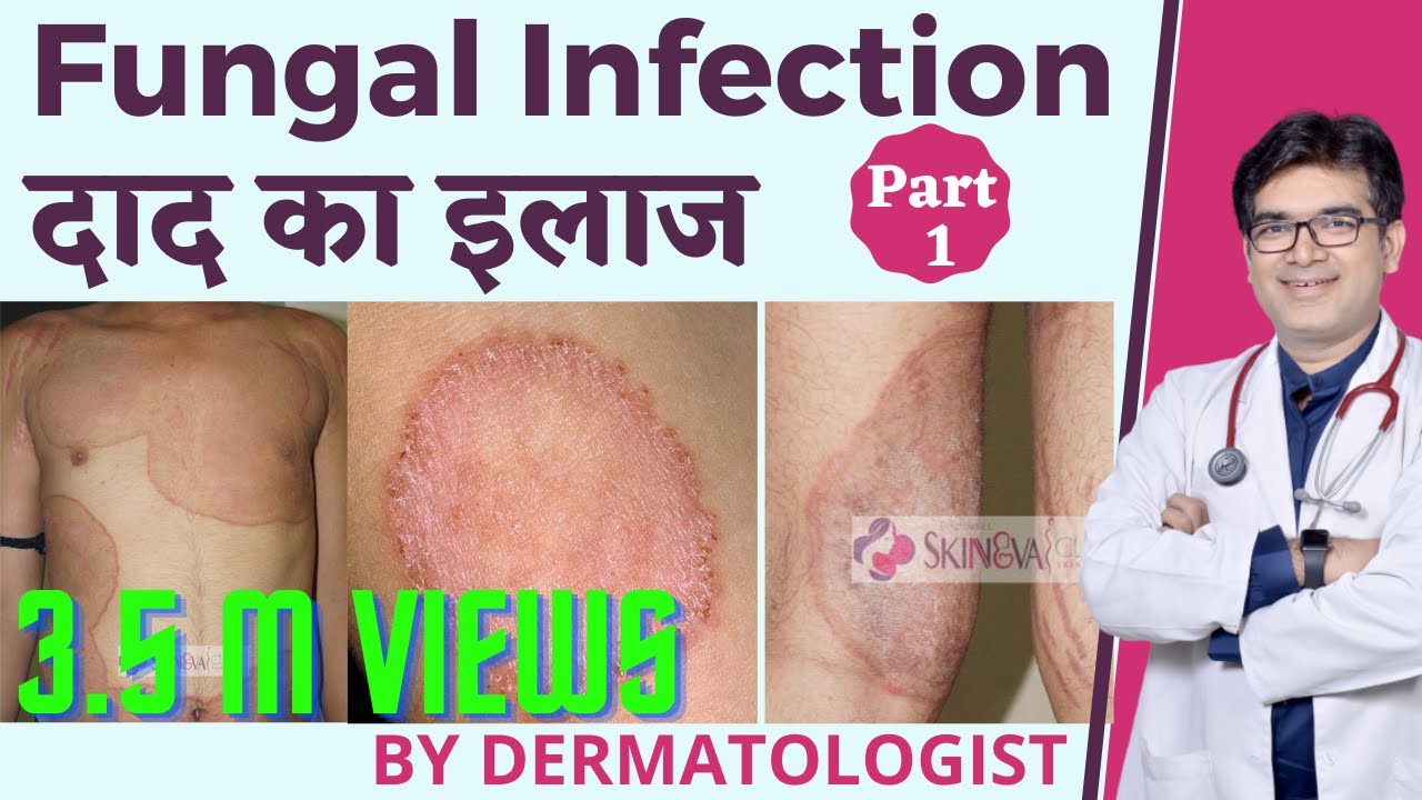 Fungal Infection Treatment In Hindi | Treatment of fungal infection in Hindi | Dermatologist | Dr...