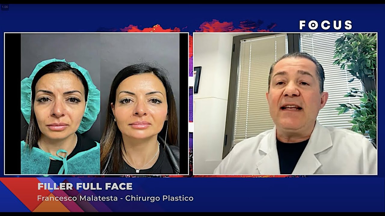 Bellezza del viso: Filler full face