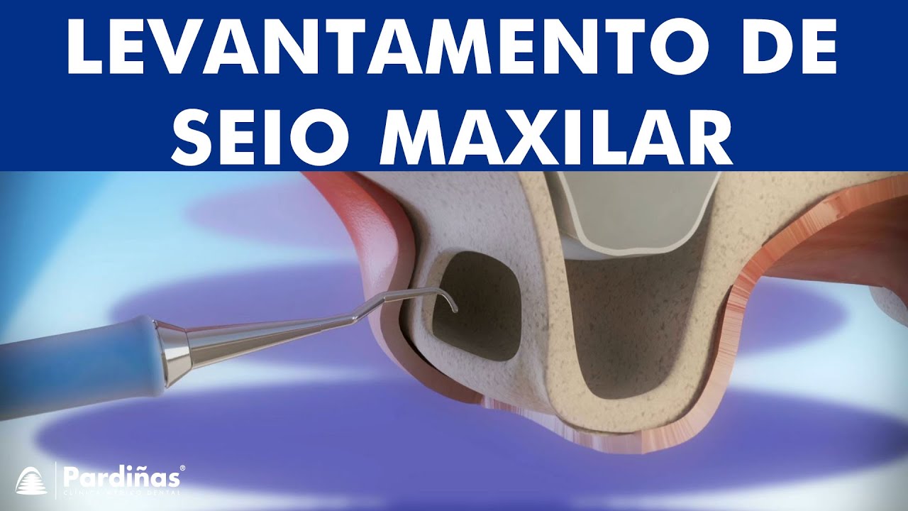 Levantamento de seio maxilar &copy;