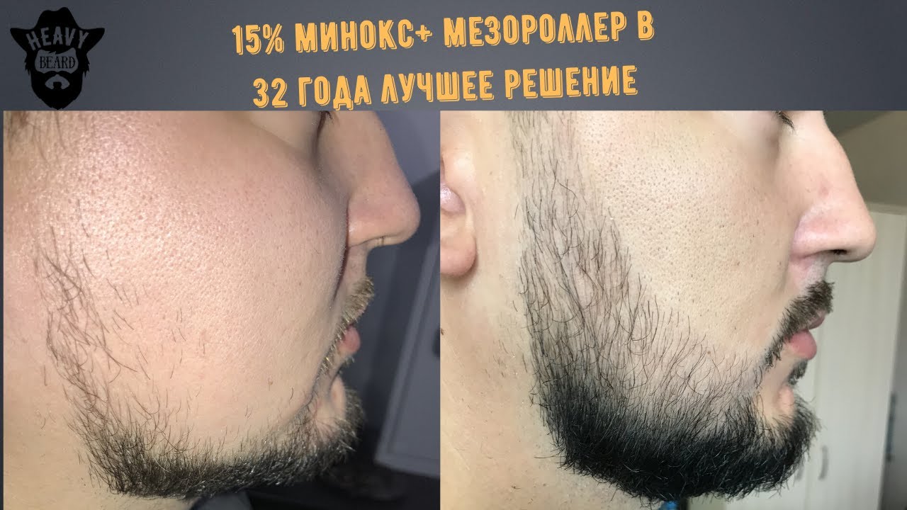 Миноксидил в 32 года, помогли только пятнашка и мезороллер