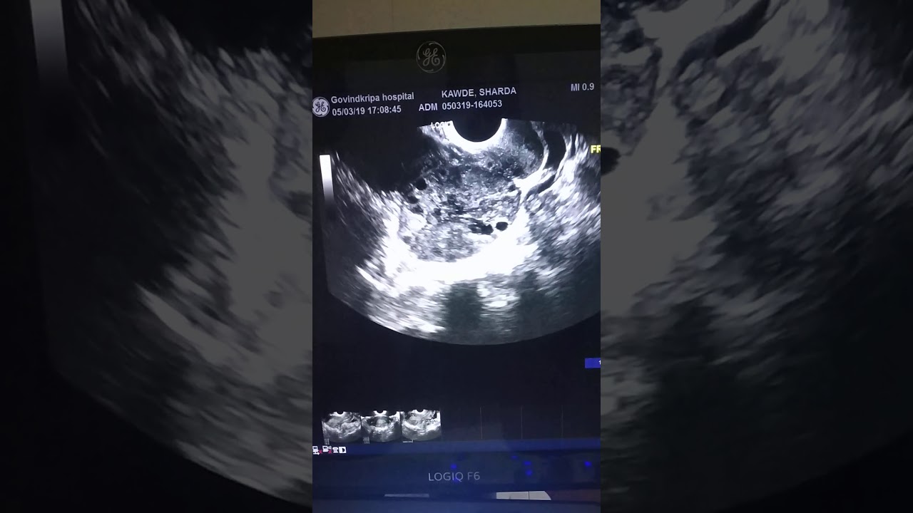 Ovarian Torsion on sonography