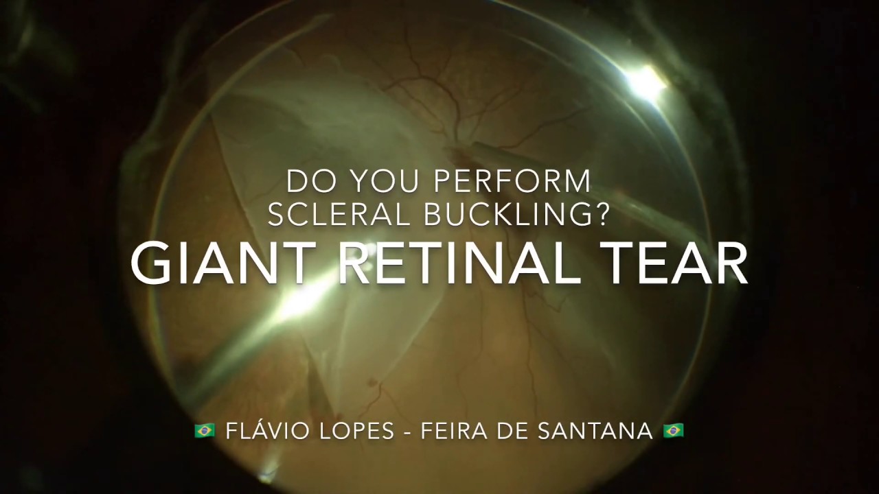 Giant retinal tear - To buckle or not - Author: Flávio Lopes MD