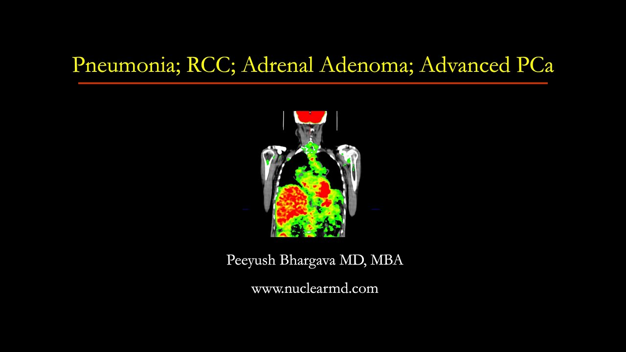 Pneumonia; RCC; Adrenal Adenoma; Advanced PCa