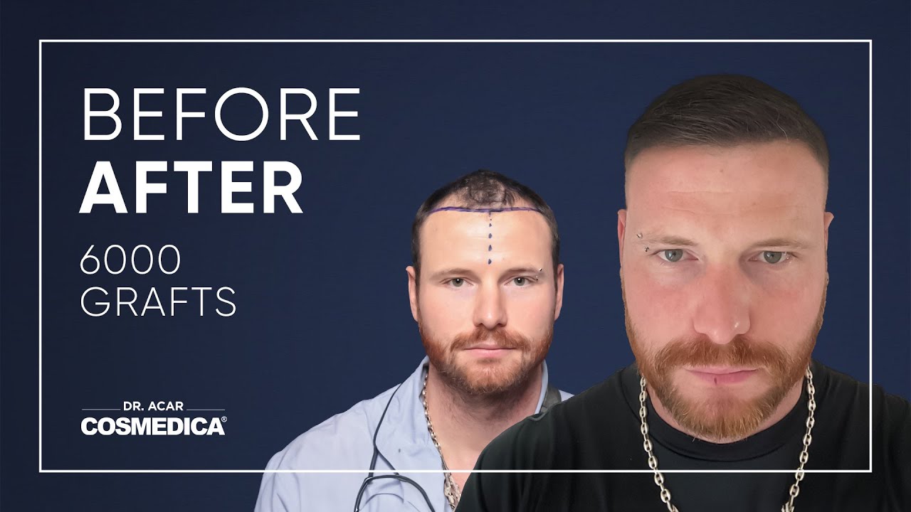 Hair Transplant in Turkey | Results | Dr. Acar | Cosmedica Clinic