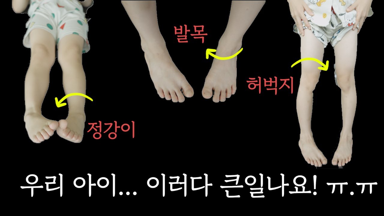 딱! 30초로 우리 아이 안짱다리 관리 하는 방법 있어요. 😲 (자주 안아달라고 하고 발에 걸려 넘어지면서 발목을 접질려요!)