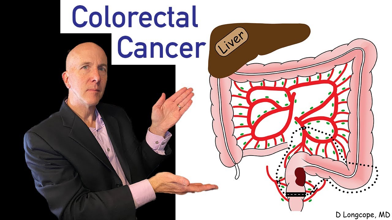 Colorectal Cancer: Full review
