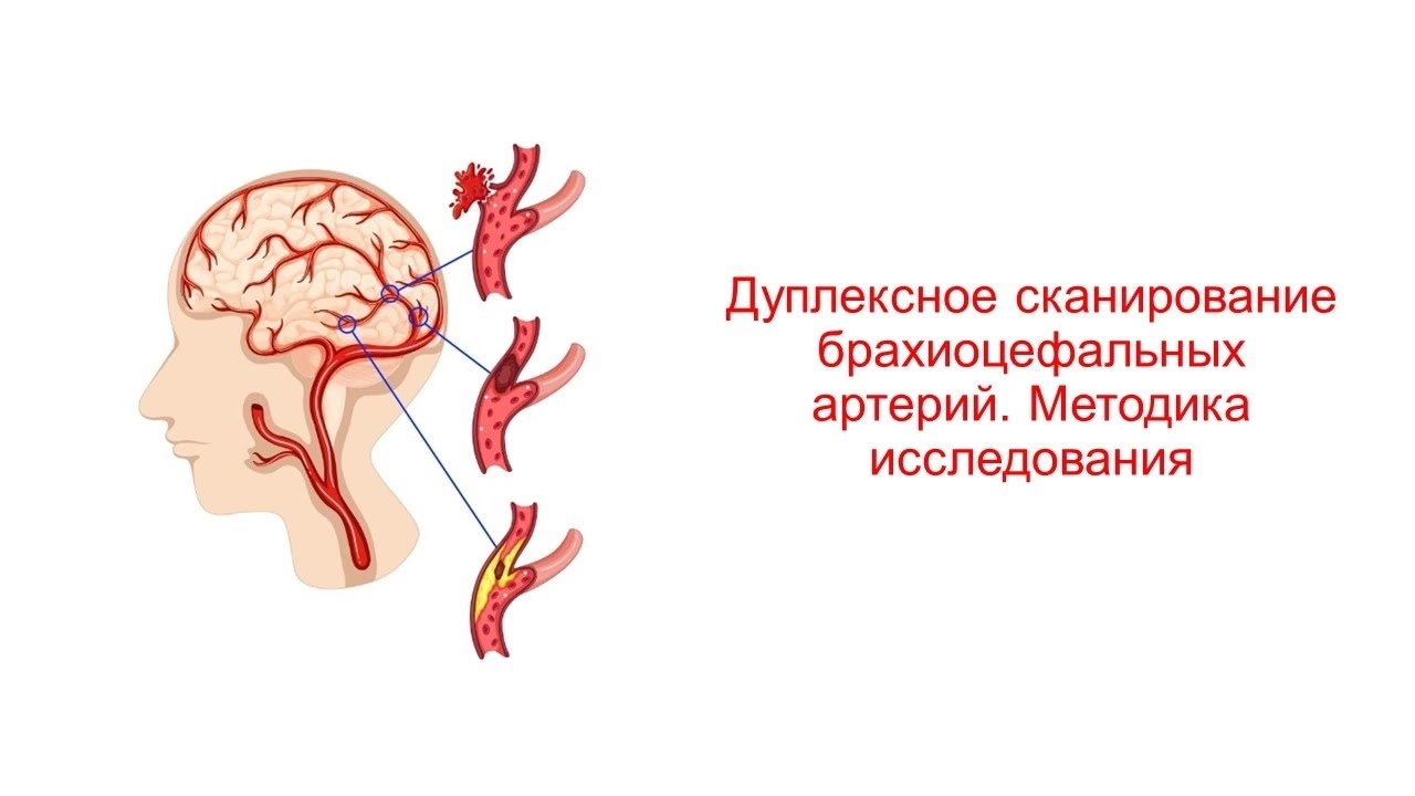 Дуплексное сканирование брахиоцефальных артерий