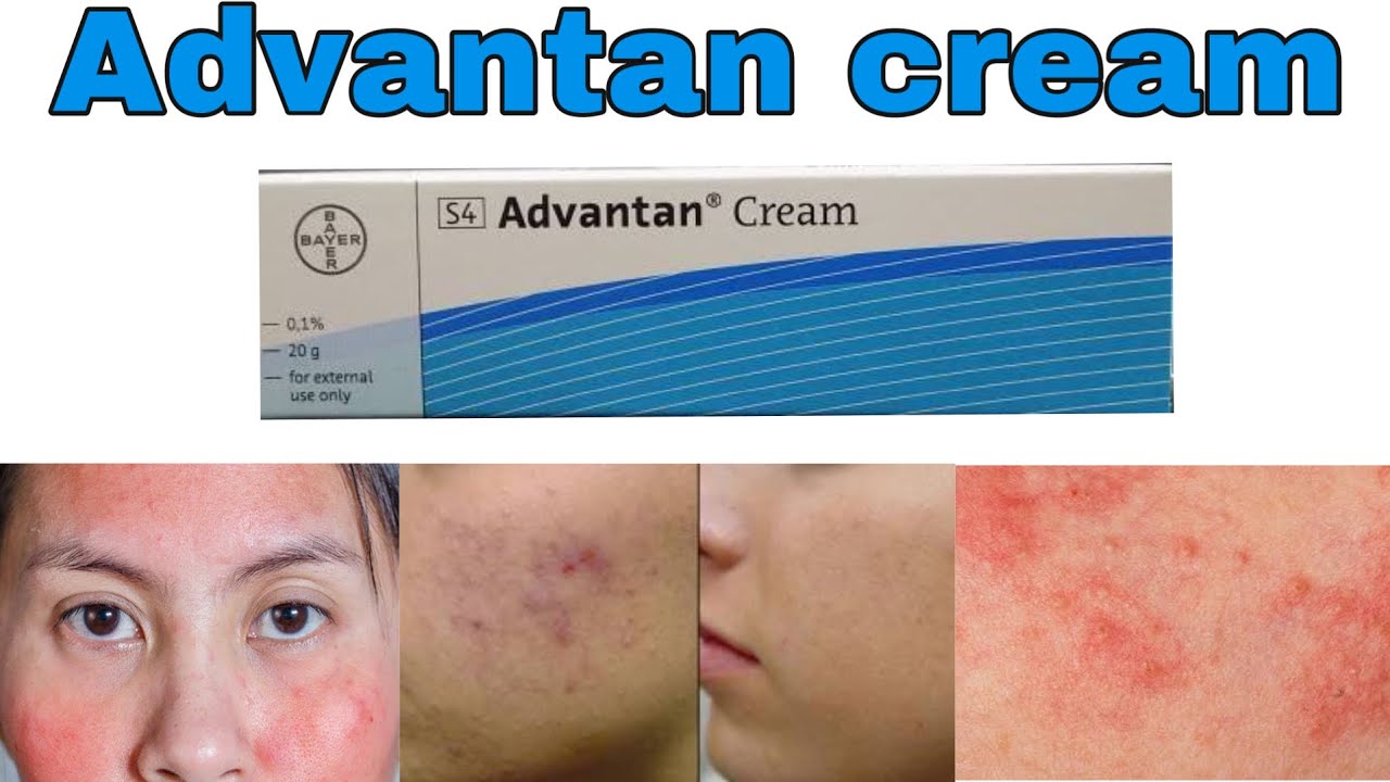 Advantan cream uses and benefits (methylprednisolone) side effects How to use for skin infections