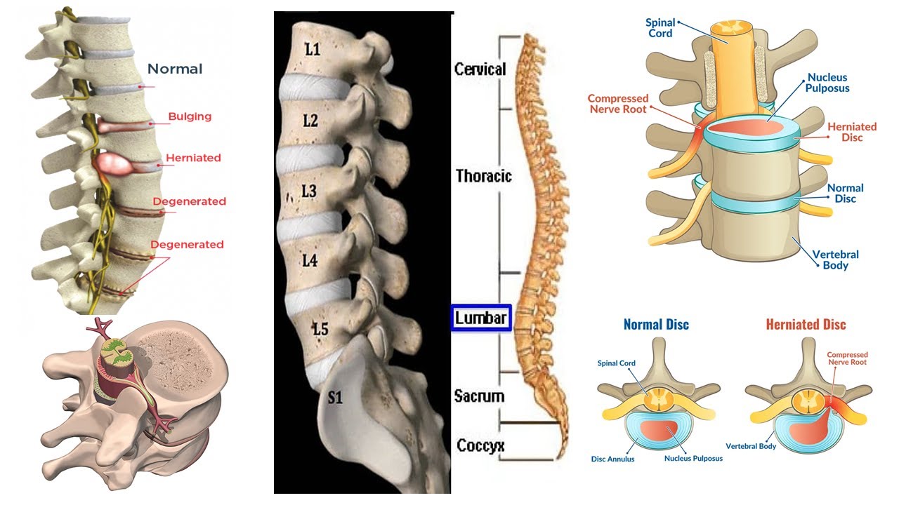 Spine and Disc Problems solution