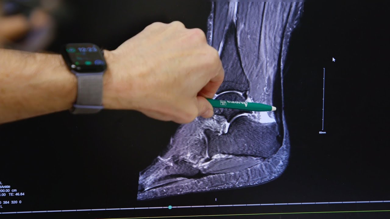 Conquer Your Pain: Overcoming Achilles Tendonitis