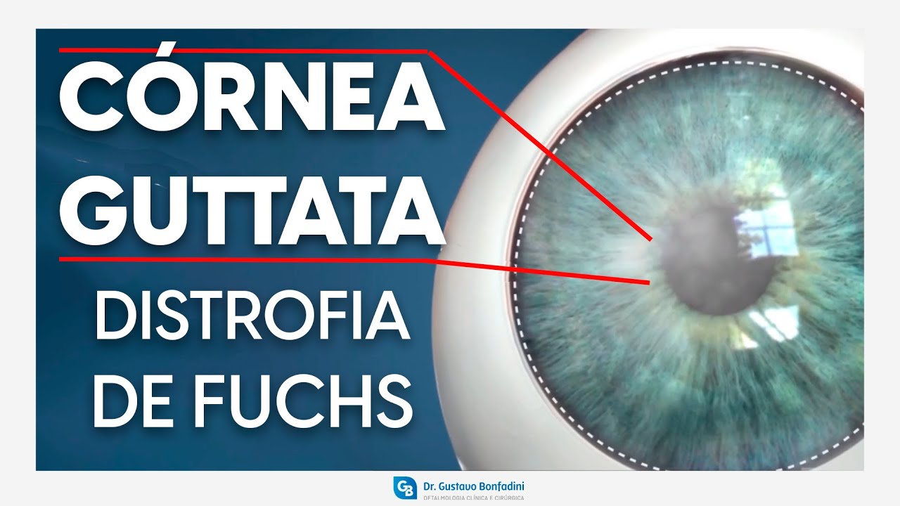 Distrofia de fuchs, cornea gutata | Dr Gustavo Bonfadini