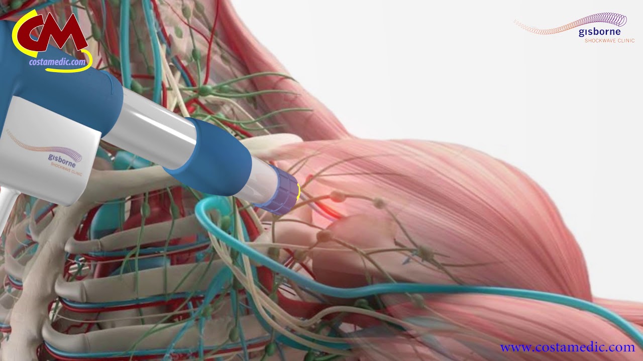 Shock-wave pain treatment