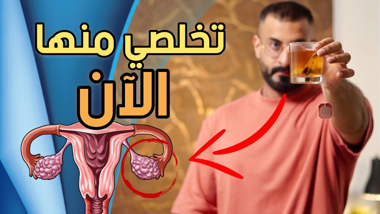 5 عادات سهلة للتخلص من تكيسات المبايض في اسرع وقت