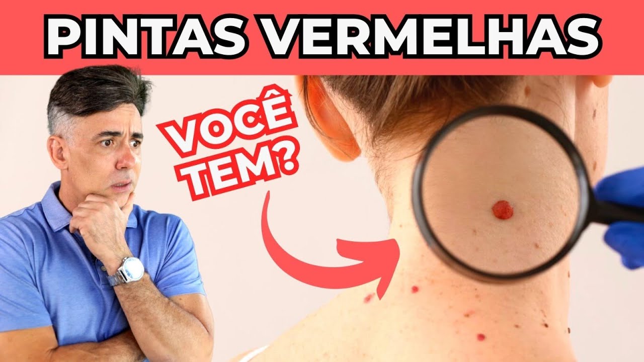 PINTAS VERMELHAS: QUAIS AS CAUSAS E COMO TRATAR? | Dr Dayan Siebra