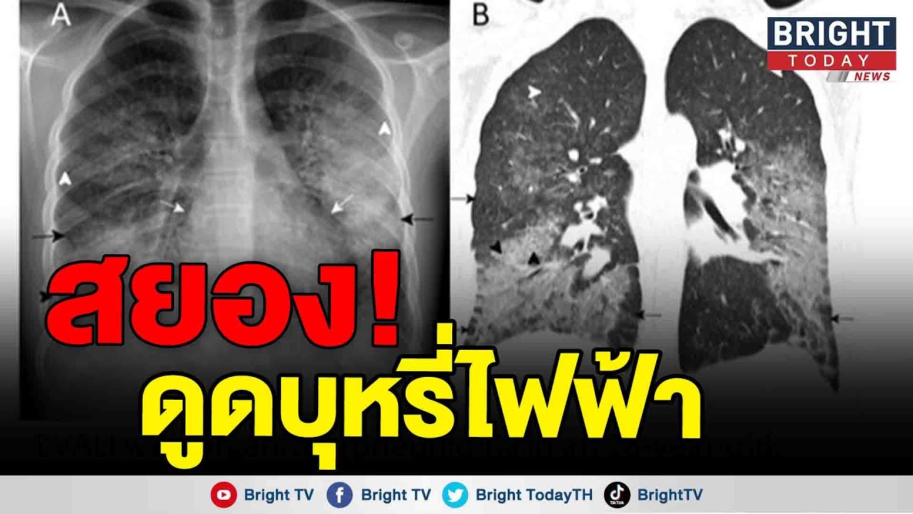 เพจดังเตือน อันตรายดูดบุหรี่ไฟฟ้า หลังพบ อายุ 10 กว่าปี  ปอดอักเสบ สภาพคล้ายรังผึ้ง